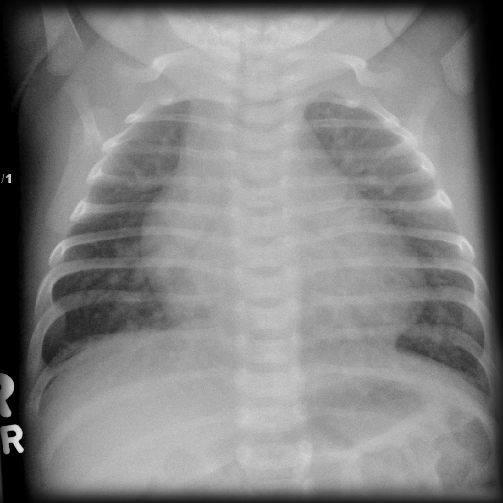 X ray showing VSD - Case courtesy of Assoc Prof Frank Gaillard, Radiopaedia.org, rID: 7445