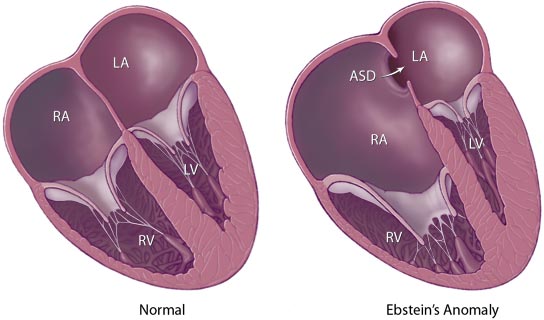 Ebstein's anomaly of the tricuspid valve - wikidoc
