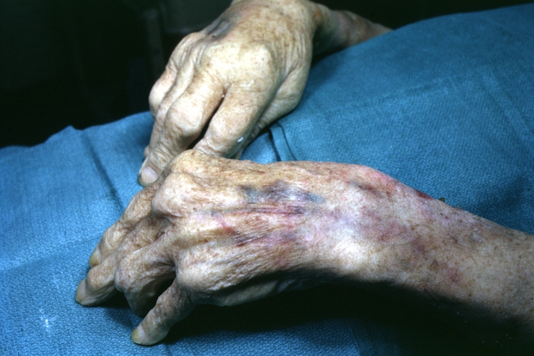 Hand: Gout: Gross view of both hand with enlarged joints