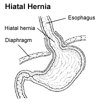 Hiatal hernia