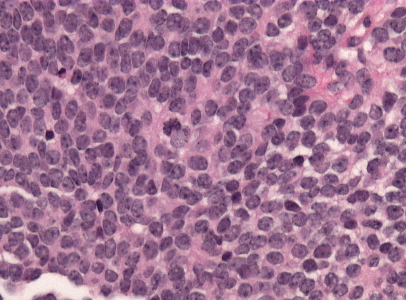 File:Pineal parenchymal tumor with intermediate differentiation microscopic 3.jpg