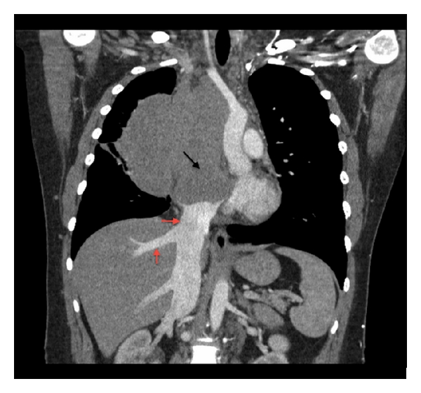 Coronal CT scan image elucidates a mediastinal mass with extension into the right atrium (black arrow) with complete encasement and compression of the SVC. The tumor extends to the confluence of the IVC in the right atrium causing dilatation of the intraabdominal IVC and hepatic veins suggesting compromised cardiac return (red arrows). Tumor causes the displacement of great vessels into the left hemithorax.[2]
