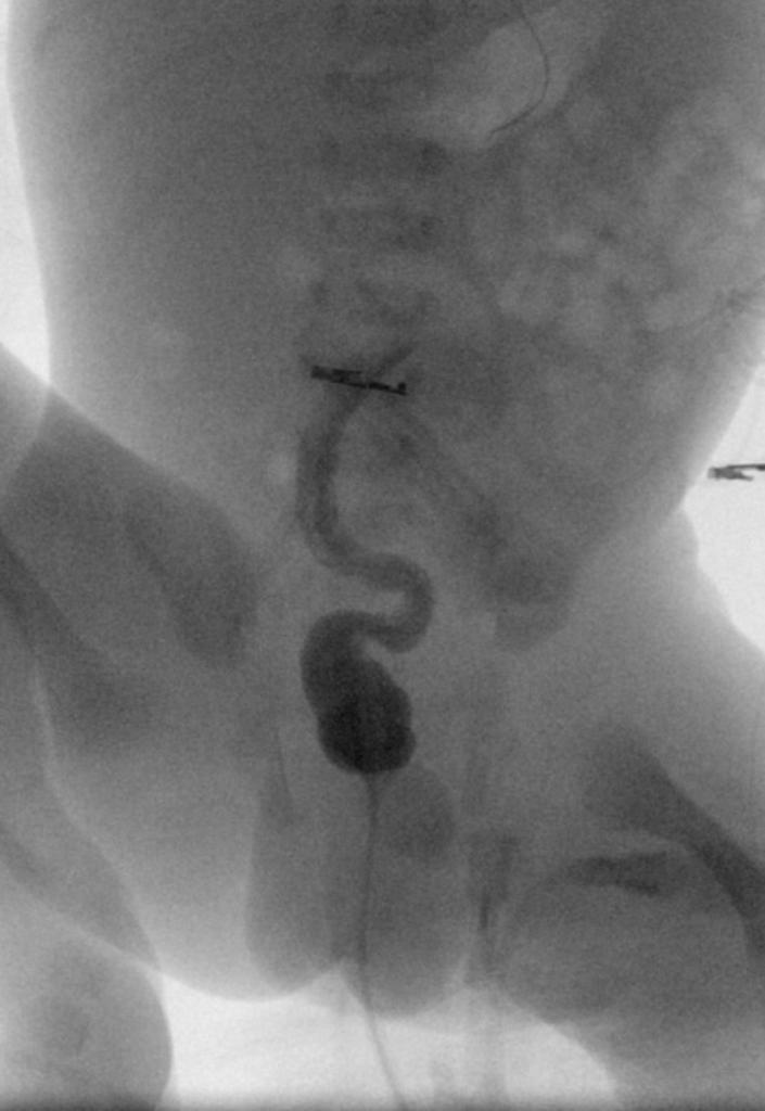File:Small-left-colon-syndrome-1 - Case courtesy of Dr Eric F Greif, Radiopaedia.org, rID 30024.jpg