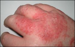 Acute dermatitis