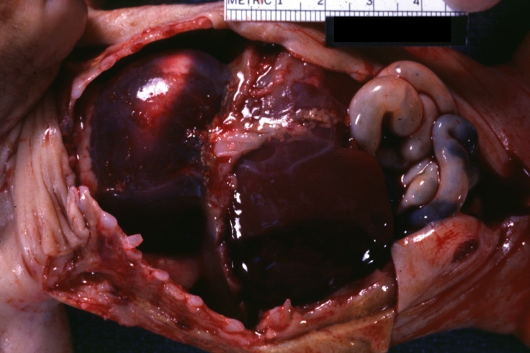 Hemopericardium in newborn: Gross, natural color, opened body with large collection blood in pericardial sac. Cause uncertain. A 26 week premature with hyaline membrane disease and DIC