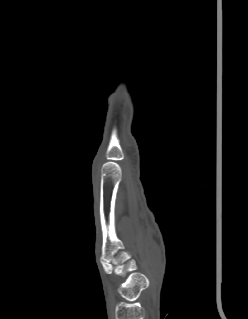 There is a displaced oblique intra-articular fracture of the fifth metacarpal base with 3 mm radial displacement of the bony fragment and mild displacement of the metacarpal bone. No other associated bone injuries were seen.