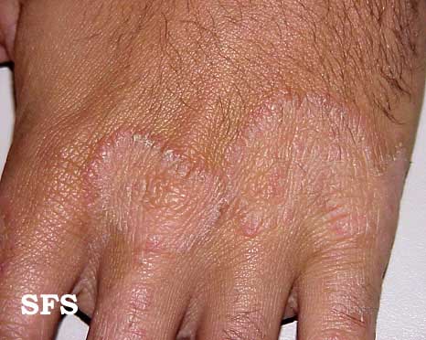 Tinea manuum. Adapted from Dermatology Atlas.[1]