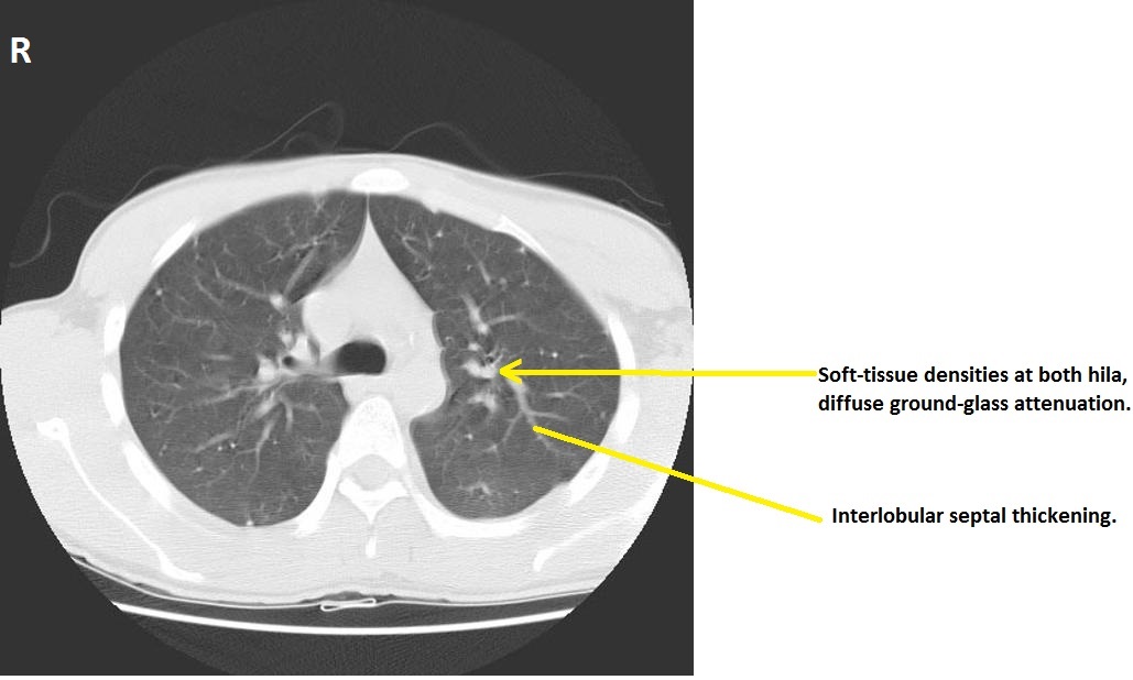 Varicella Pneumonia CT - 1 (Marked).jpg